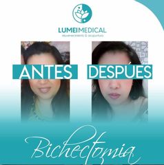Bichectomía - Lumei Medical