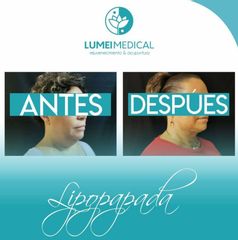 Lipopapada -  Lumei Medical