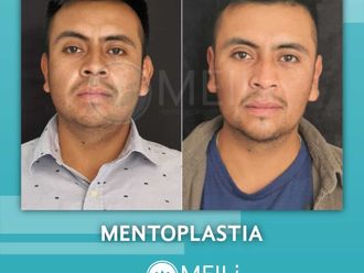 Mentoplastia antes y después - 844799