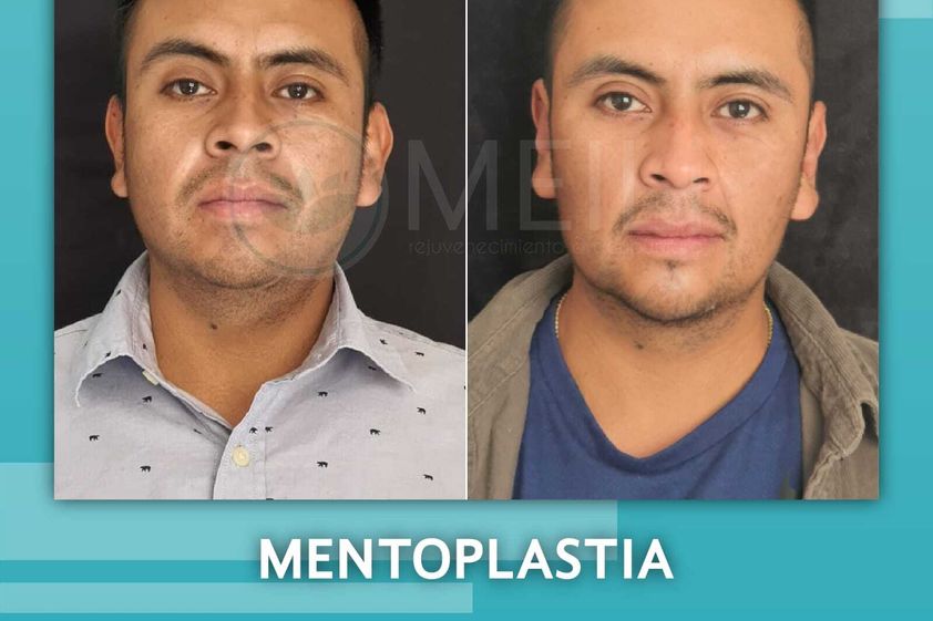 Mentoplastia antes y después - 844799