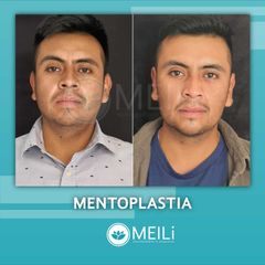 Mentoplastia - MEILi - Rejuvenecimiento