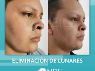 Eliminación de lunares antes y después - 844801