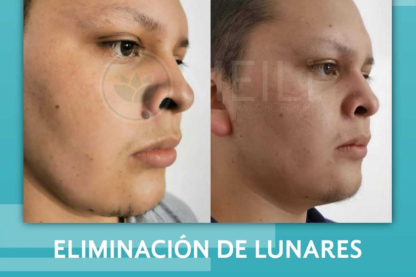 Eliminación de lunares antes y después - 844801
