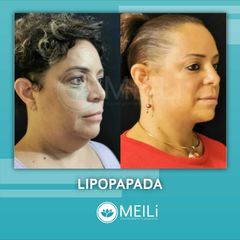 Lipopapada -  MEILi -Rejuvenecimiento