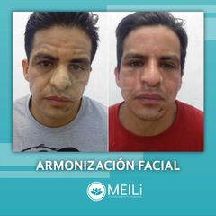 Armonización facial - MEILi