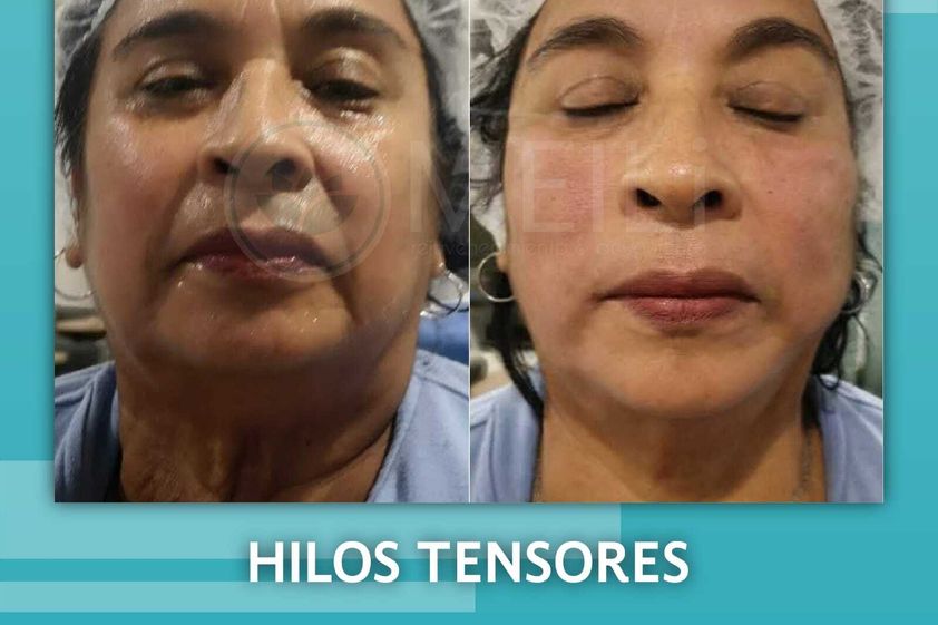Hilos tensores antes y después - 844805