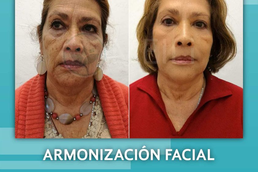 Ácido hialurónico antes y después - 844808