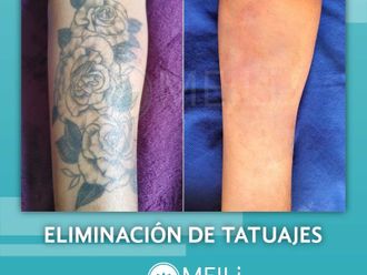 Eliminación de tatuajes antes y después - 844809