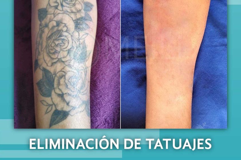 Eliminación de tatuajes antes y después - 844809