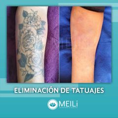 Eliminación de tatuajes - MEILi - Rejuvenecimiento