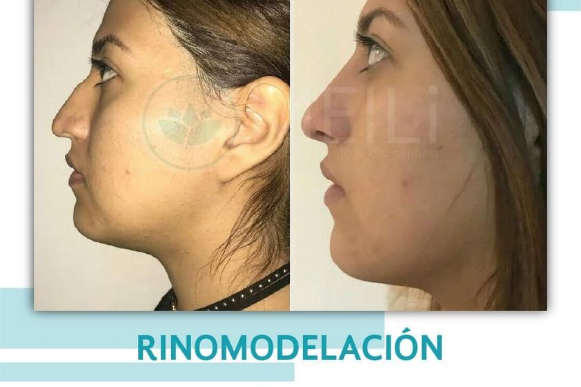 Rinomodelación antes y después - 869000