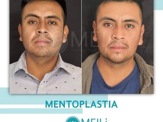 Mentoplastia antes y después - 869001