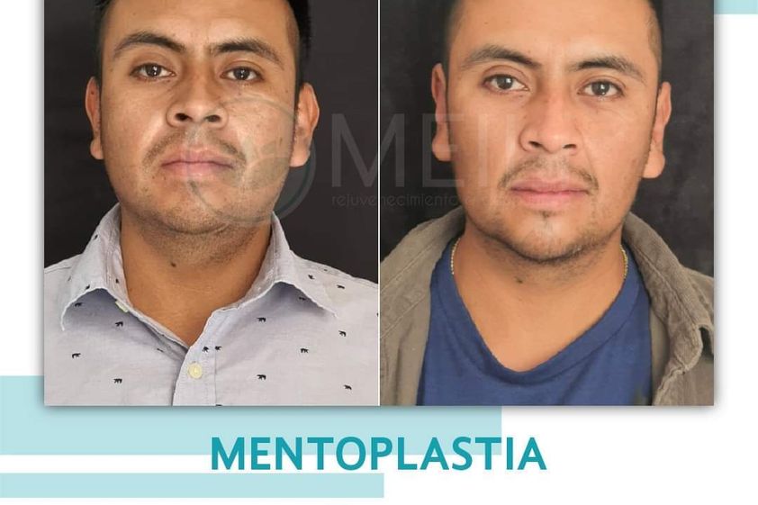 Mentoplastia antes y después - 869001