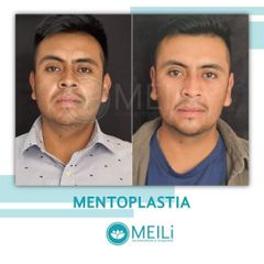 Mentoplastia - MEILi - Rejuvenecimiento