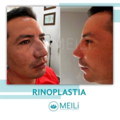 Rinoplastia - MEILi - Rejuvenecimiento