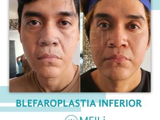 Blefaroplastia antes y después - 869014