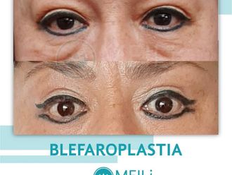 Blefaroplastia antes y después - 869016