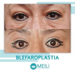 Blefaroplastia - MEILi -  Rejuvenecimiento