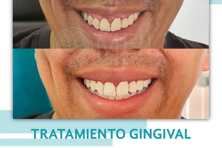 Toxina botulínica antes y después - 869017