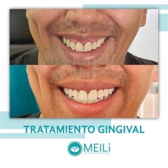 Sonrisa Gingival - MEILi -  Rejuvenecimiento