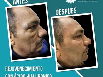 Rejuvenecimiento facial antes y después - 869018