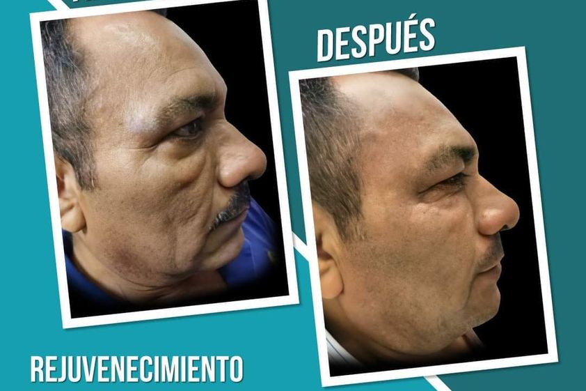 Rejuvenecimiento facial antes y después - 869018