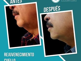 Rejuvenecimiento facial antes y después - 869020