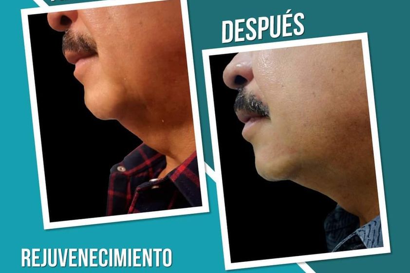 Rejuvenecimiento facial antes y después - 869020
