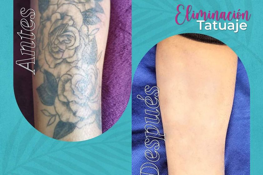 Eliminación de tatuajes antes y después - 869191