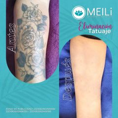 Eliminación de tatuajes - MEILi -  Rejuvenecimiento