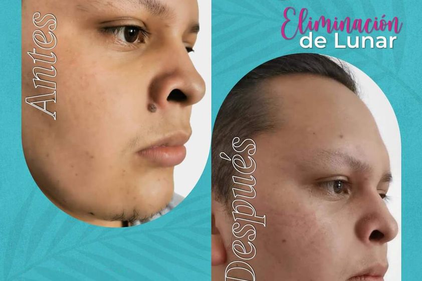 Eliminación de lunares antes y después - 869192