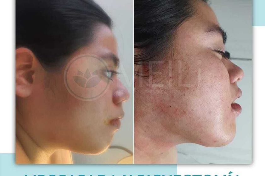 Cirugía de papada antes y después - 871345
