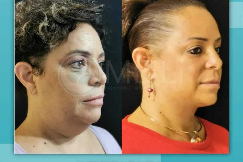 Cirugía de papada antes y después - 871346