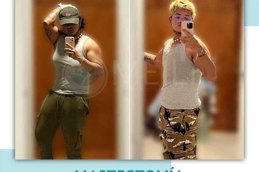 Reducción de mamas antes y después - 871347