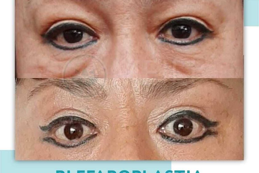 Blefaroplastia antes y después - 871349