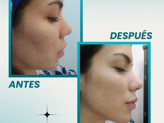 Ácido hialurónico antes y después - 877631