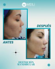 Definición Mandibular - MEILi Rejuvenecimiento