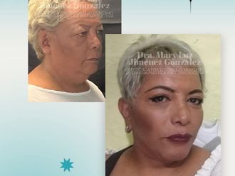 Rejuvenecimiento facial antes y después - 877632
