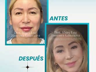 Lifting antes y después - 877633