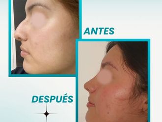 Rinoplastia antes y después - 877634