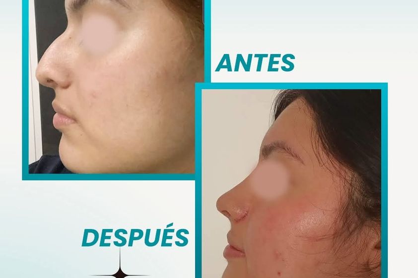 Rinoplastia antes y después - 877634