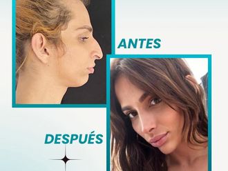 Cirugía facial antes y después - 877635