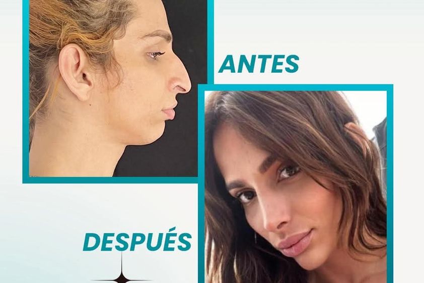 Cirugía facial antes y después - 877635