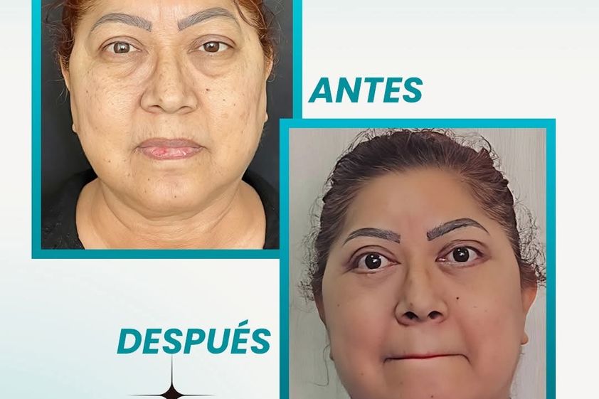 Blefaroplastia antes y después - 877636