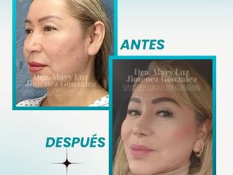 Lifting antes y después - 877637