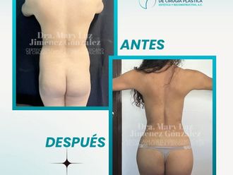 Lipoescultura antes y después - 877638