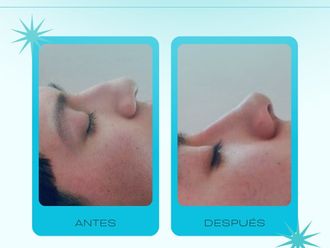 Rinomodelación antes y después - 878711