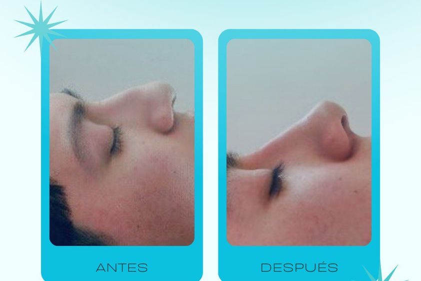 Rinomodelación antes y después - 878711