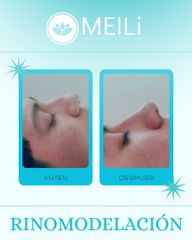 Rinomodelación - MEILi Rejuvenecimiento
