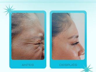 Toxina botulínica antes y después - 878712